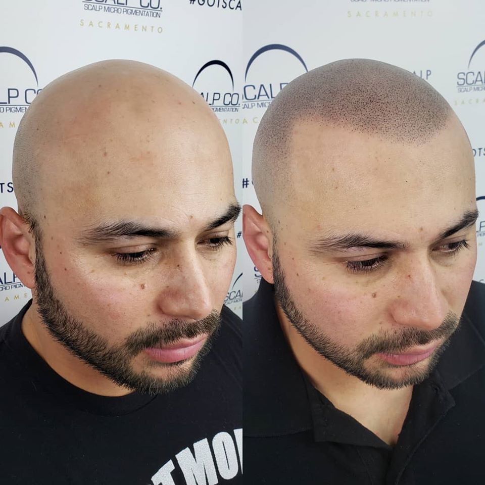 Scalp Co. Scalp Micro Pigmentation Appointments