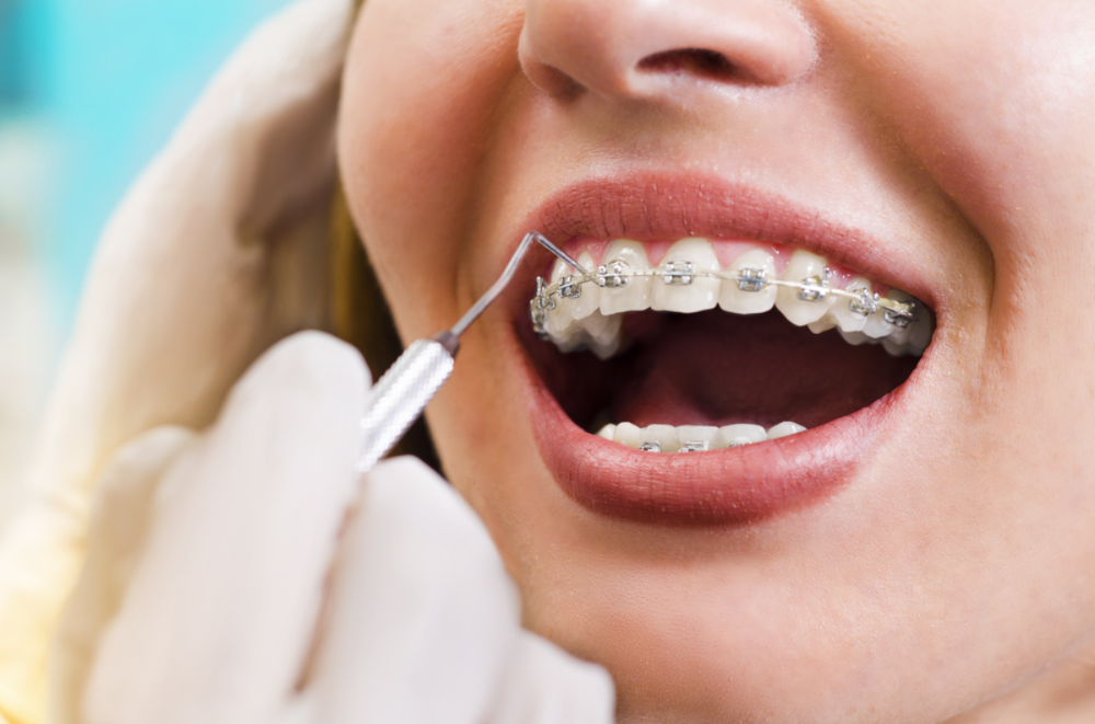 iSmiles Orthodontics - Irvine Orthodontics