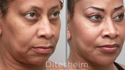 Ditesheim Cosmetic Surgery - Charlotte Onlineevent
