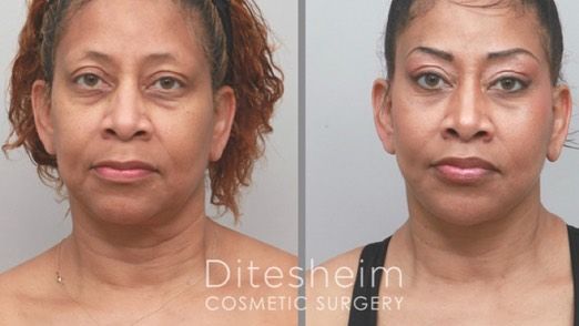 Ditesheim Cosmetic Surgery - Charlotte Informative
