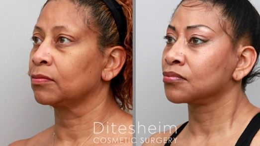 Ditesheim Cosmetic Surgery - Charlotte Accommodate