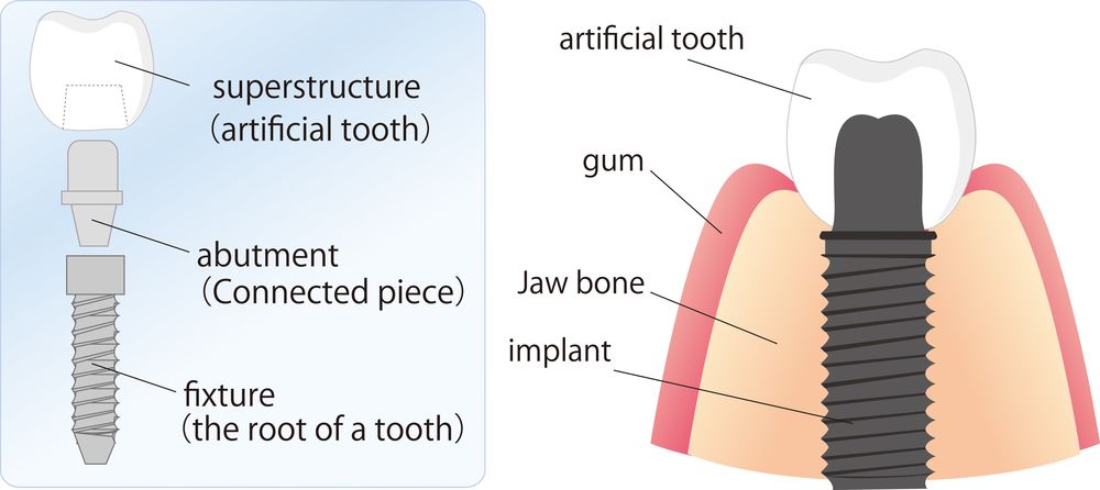 Take 2 Dental Implant Center - Anchorage Combination