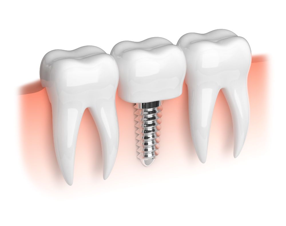 Bismarck Advanced Dental and Implants - Bismarck Webpagedepot