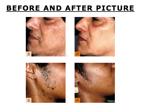 Laser Hair Removal of NY, Electrolysis By Celina Unisex Beauty Salon - South Richmond Hill Informative